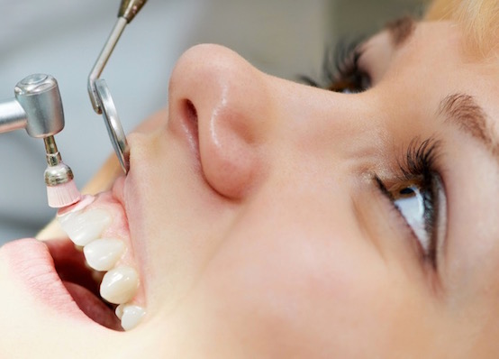 Limpieza Dental